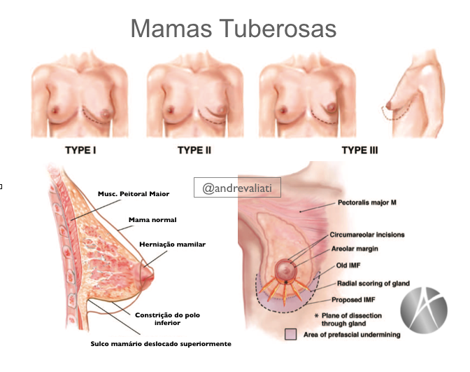 O que é Mama Tuberosa
