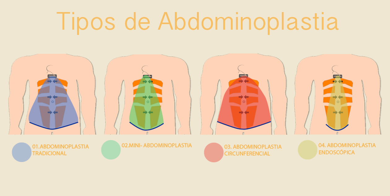 Quais são os tipos de Abdominoplastia